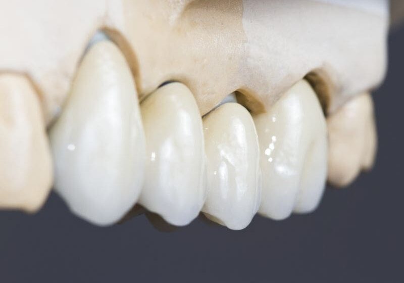 Model of crowns on teeth