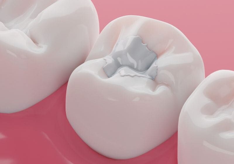Image of a dental filling